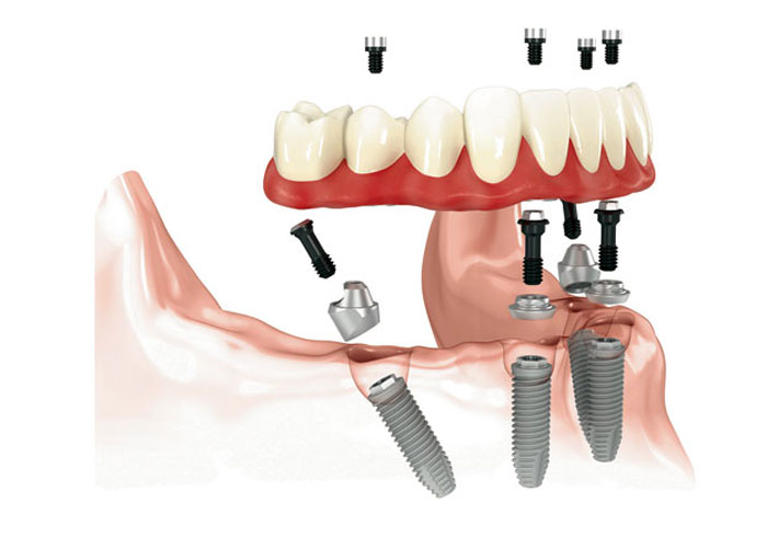 all on 4 dental implants orange county ca