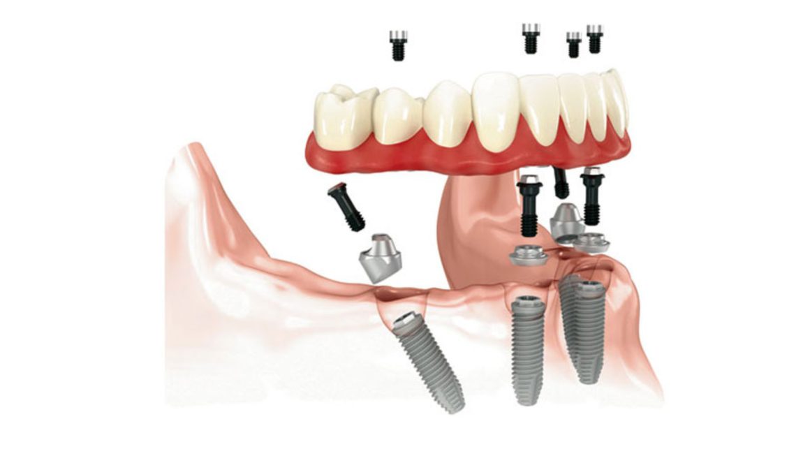 all on 4 dental implants oc