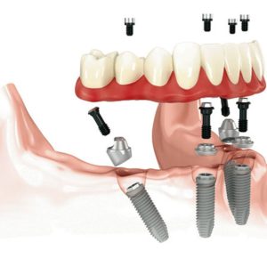 all on 4 dental implants oc